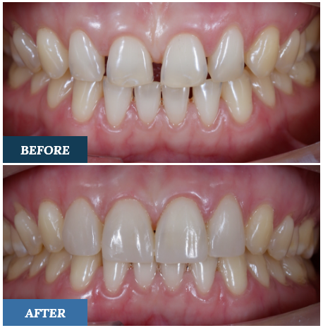 Composite Bonding Before and After one