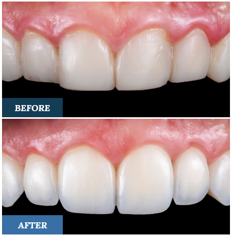 Composite Bonding Before and After three