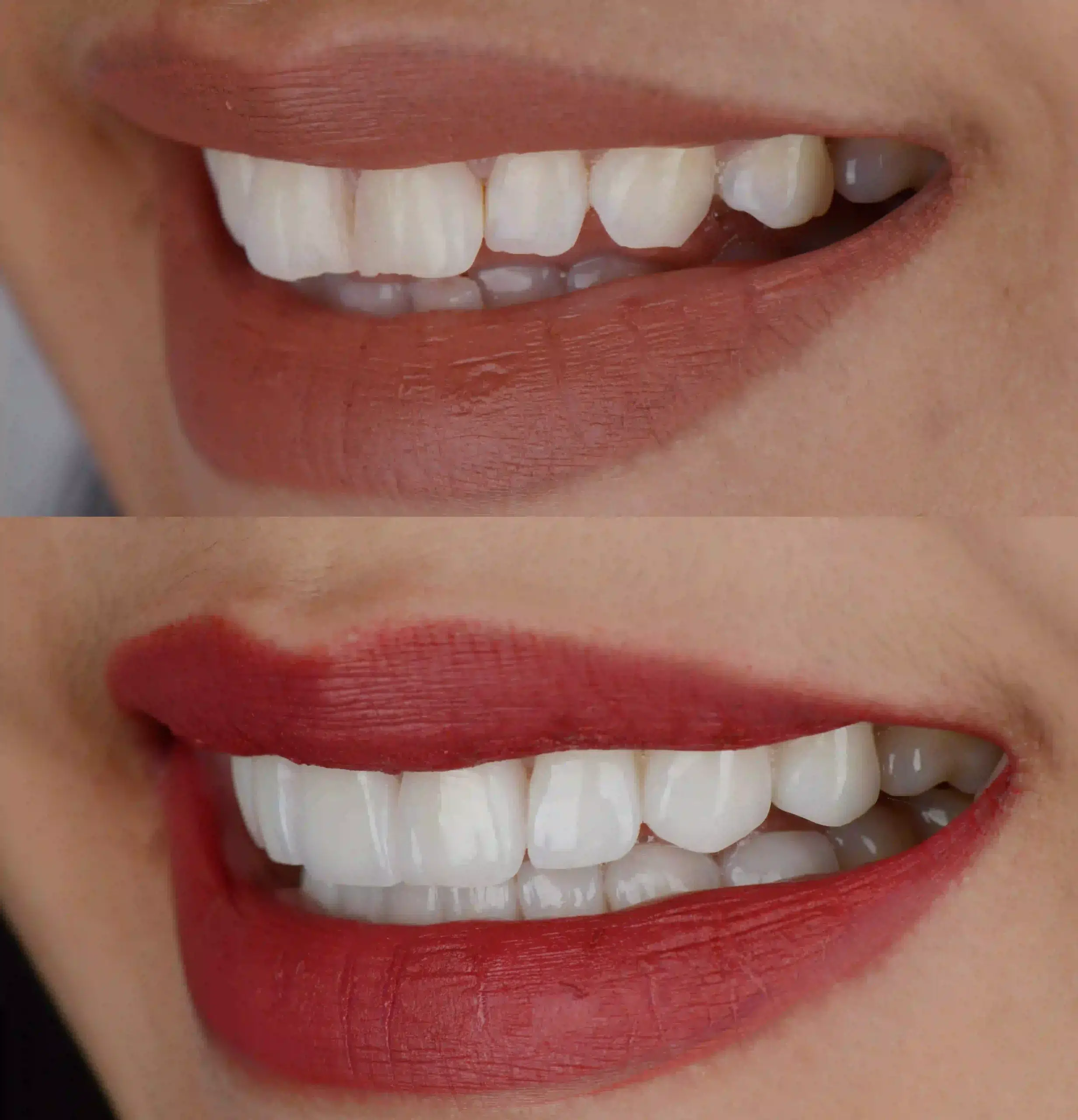 Cosmetic Dentistry Before and After one scaled