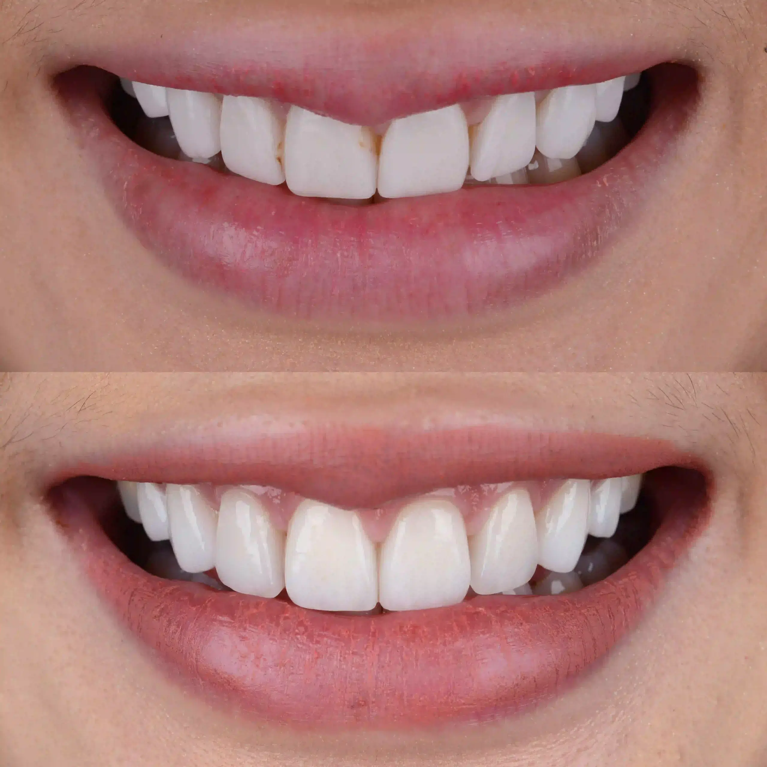 Cosmetic Dentistry Before and After three scaled