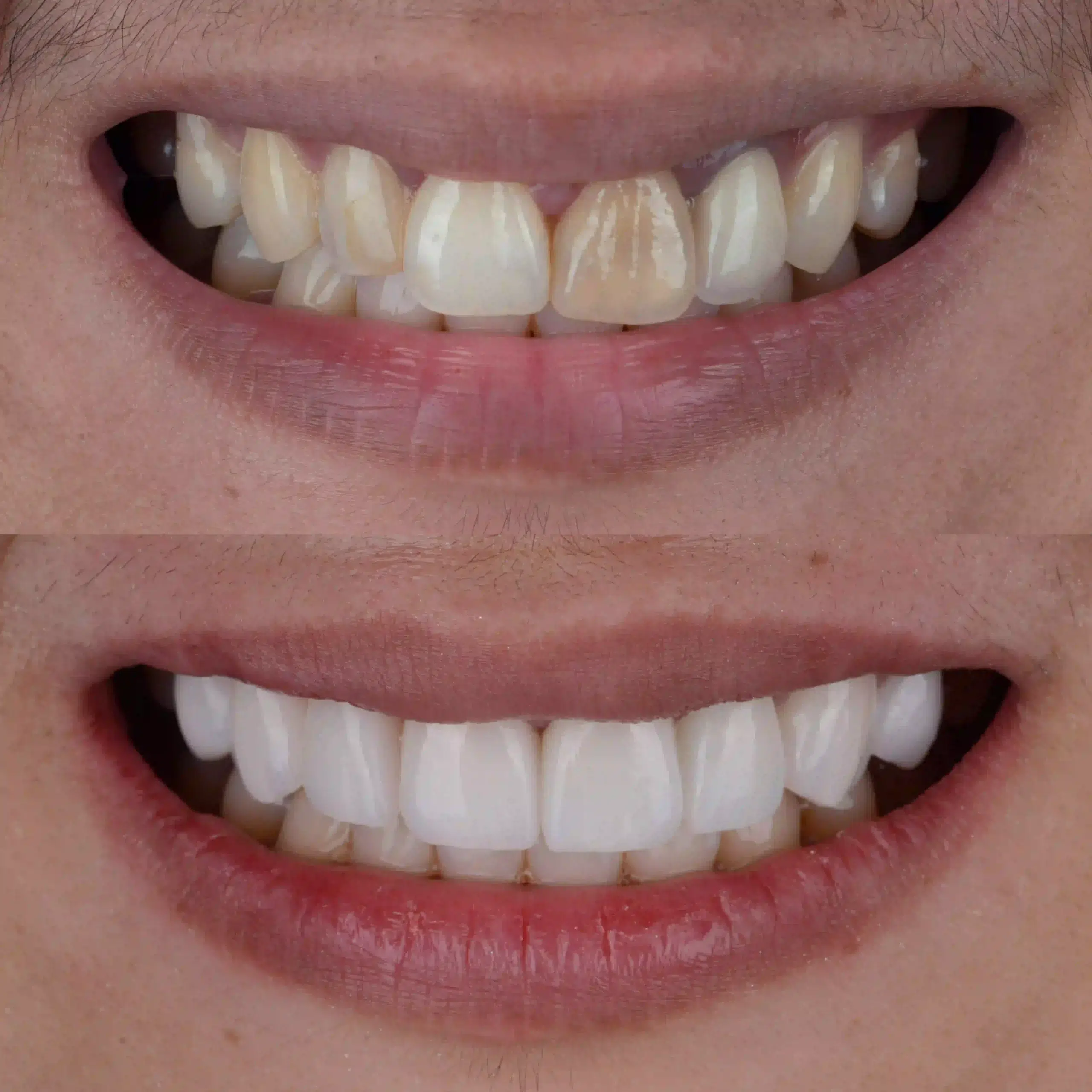 Cosmetic Dentistry Before and After two scaled