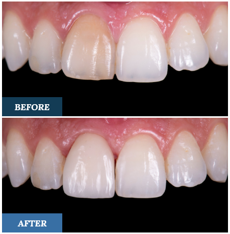 Crowns Before and After one