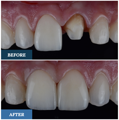 Crowns Before and After six