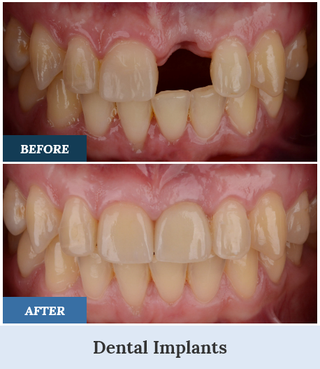 Dental Implants Before and After one home