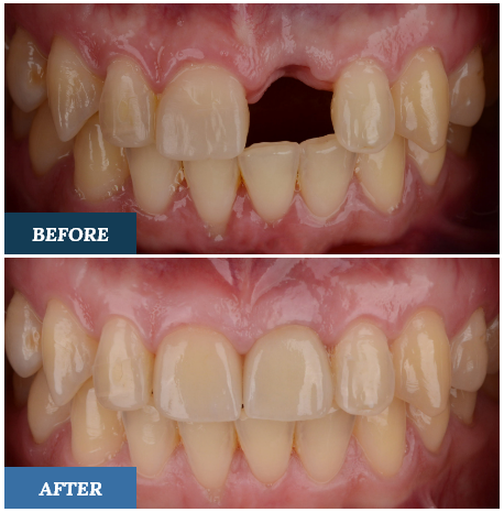 Dental Implants Before and After one