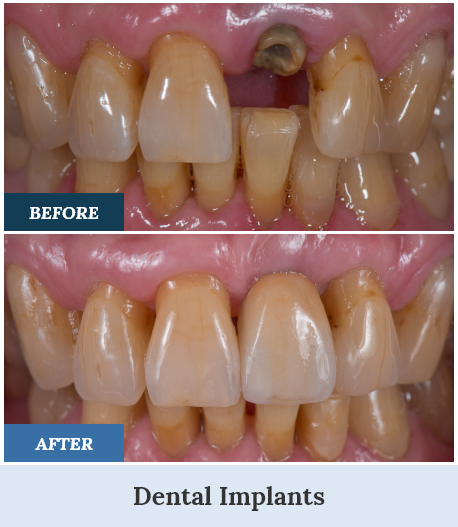 Dental Implants Before and After two home