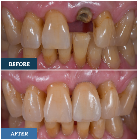 Dental Implants Before and After two