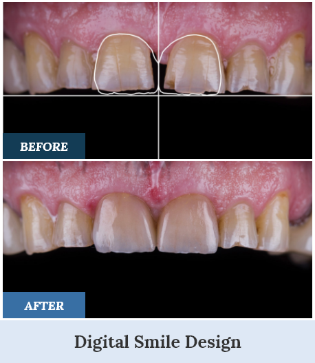 Digital Smile Design Before and After one home