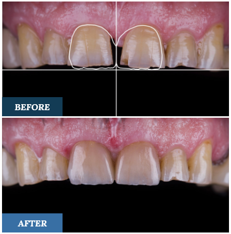 Digital Smile Design Before and After one
