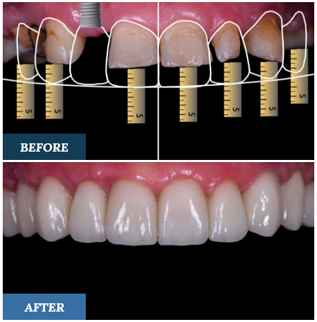 Digital Smile Design Before and After two