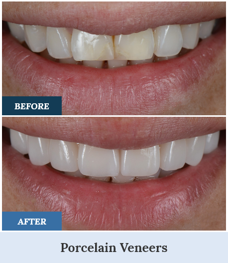 Porcelain Veneers Before and After one home