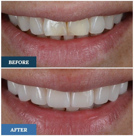 Porcelain Veneers Before and After one