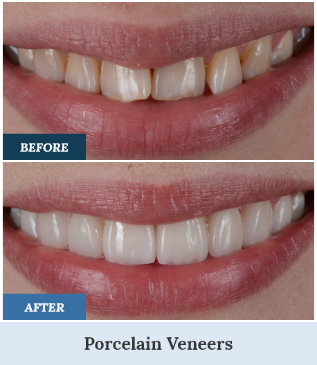 Porcelain Veneers Before and After two home