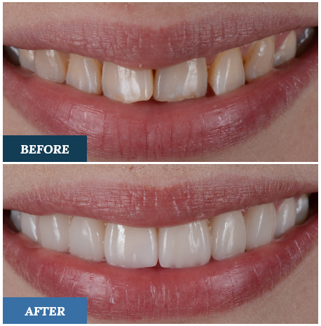Porcelain Veneers Before and After two