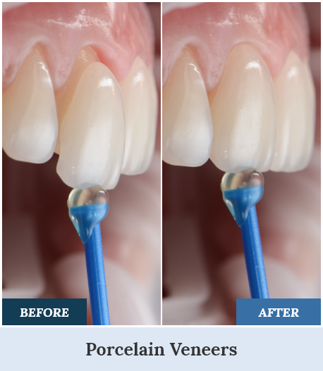 Porcelain Veneers before after one home
