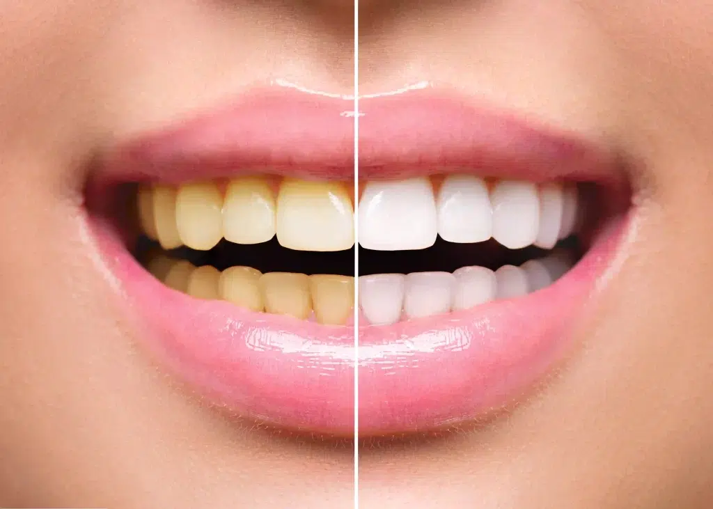 Professional Teeth Whitening scaled