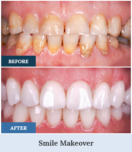 Smile Makeovers before and after five home