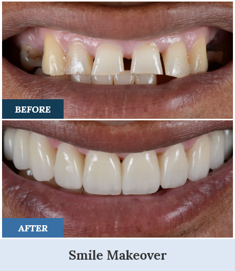 Smile Makeovers before and after one home