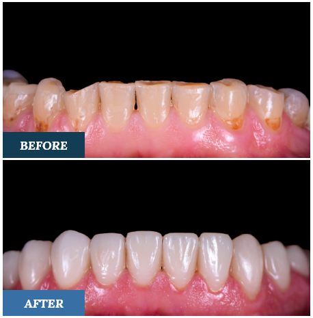 Smile Makeovers before and after six 1