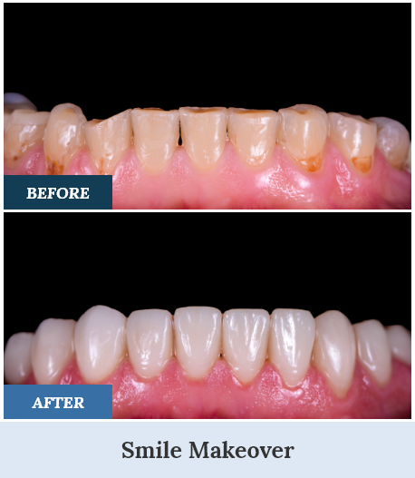 Smile Makeovers before and after six home