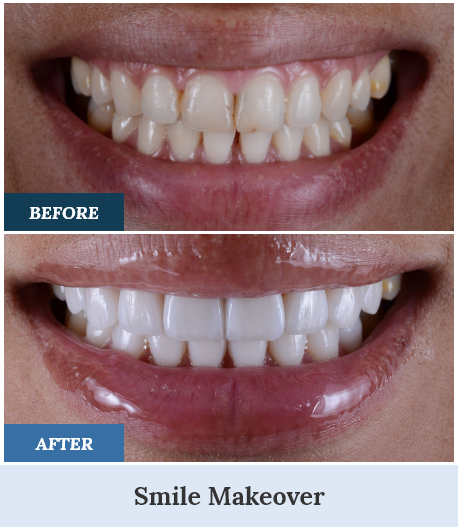 Smile Makeovers before and after three home