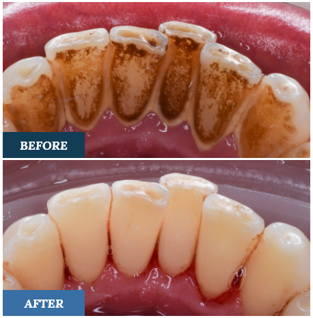 Teeth Cleaning Before and After ONE