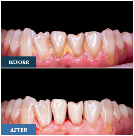 Teeth Cleaning Before and After TWO