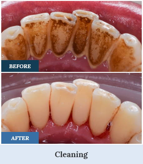Teeth Cleaning Before and After one home