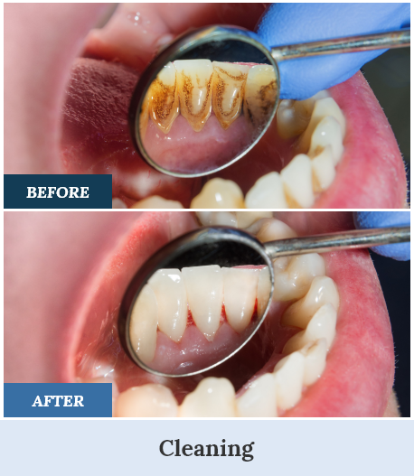Teeth Cleaning Before and After three home