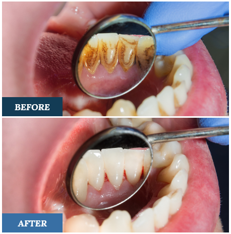 Teeth Cleaning Before and After three