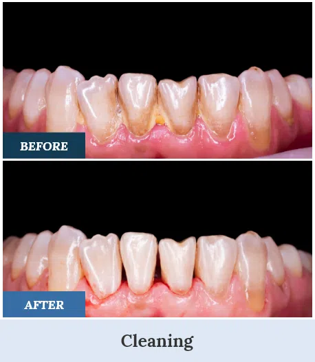Teeth Cleaning Before and After two home