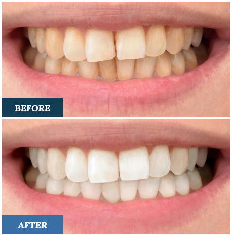 Teeth Whitening Before and After one
