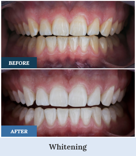 Teeth Whitening Before and After two home