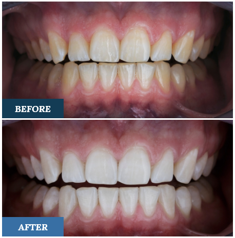 Teeth Whitening Before and After two
