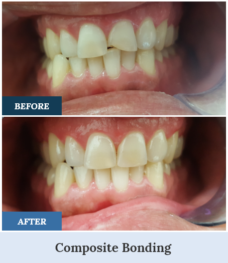 Composite Bonding Before and After four home page